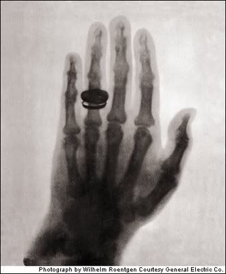 Foto Manusia Dengan Sinar Rontgen Pertama (1896)